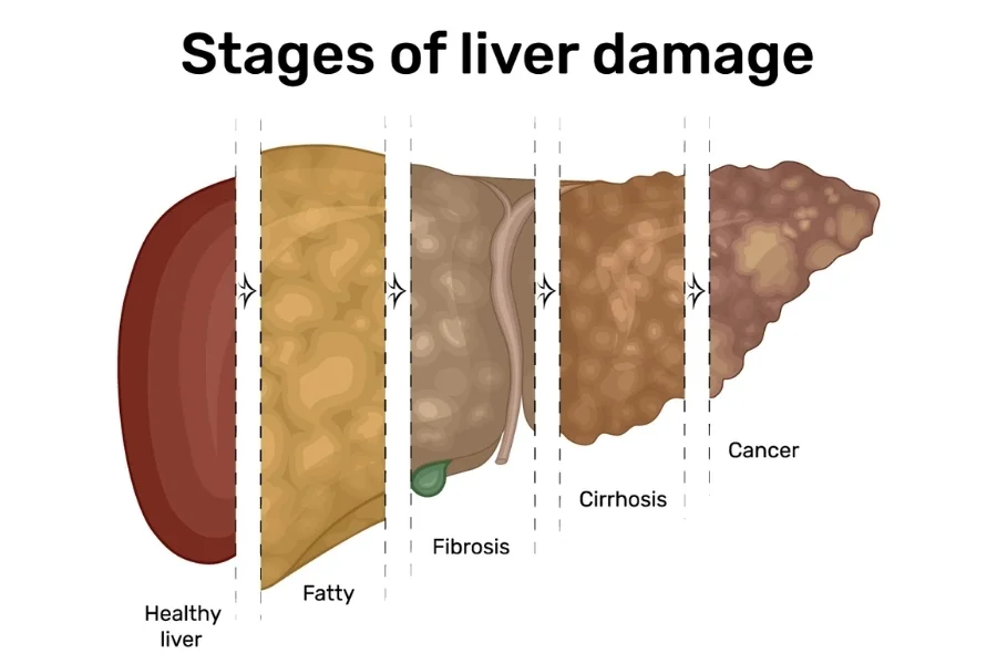 Liver Failure