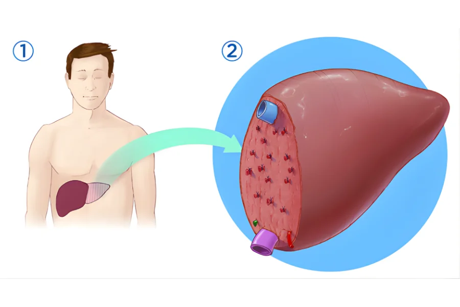 Living Donor Liver Transplant