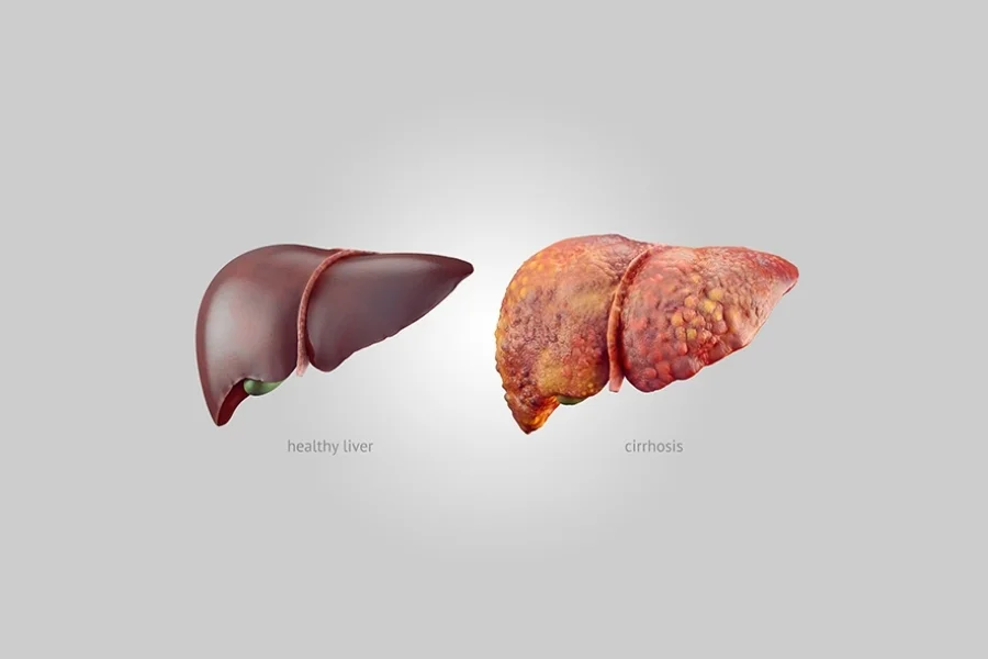 Liver Cirrhosis